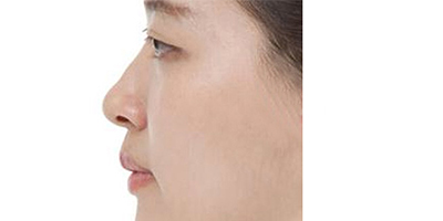 假體墊鼻基底術前