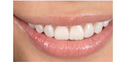 注射去露齦笑術(shù)后