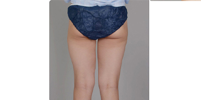 隔空溶脂瘦臀部術(shù)前