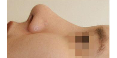 硅膠隆鼻術(shù)后