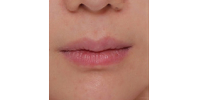 唇部綜合術(shù)前