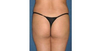 假體豐臀術(shù)前