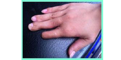 手指巨指矯正術(shù)后