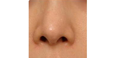 鼻部膨體假體取出術(shù)前