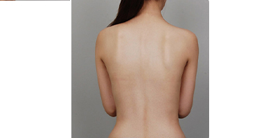 超聲溶脂瘦腰部術(shù)后