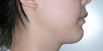 上顎前突/天包地術后