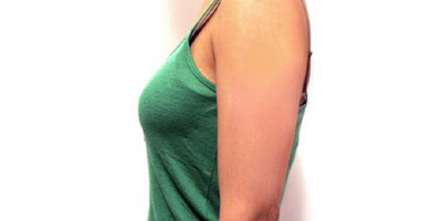 水動(dòng)力吸脂術(shù)前