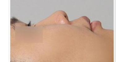 玻尿酸隆鼻術前