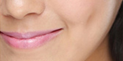 酒窩成形術(shù)術(shù)后