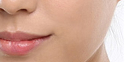 酒窩成形術(shù)術(shù)前