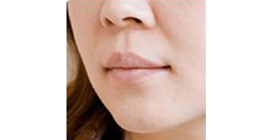 玻尿酸豐唇術前