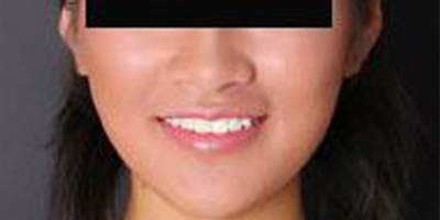 取頰脂墊瘦臉術(shù)后