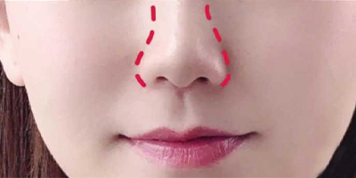 注射縮鼻頭術(shù)后