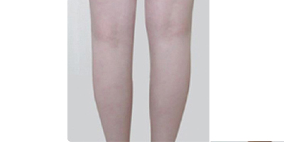 動(dòng)氧瘦小腿術(shù)后