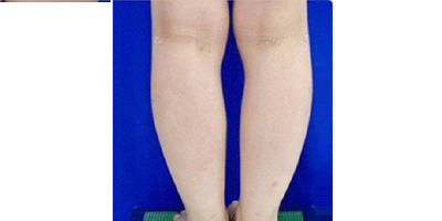 共振吸脂術(shù)術(shù)后