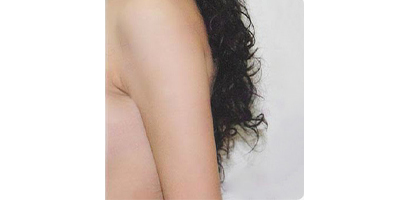 射頻溶脂瘦手臂術(shù)后