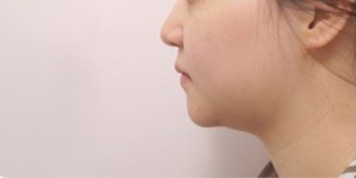 激光溶脂瘦臉術前