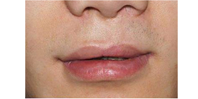 唇部修復(fù)術(shù)后