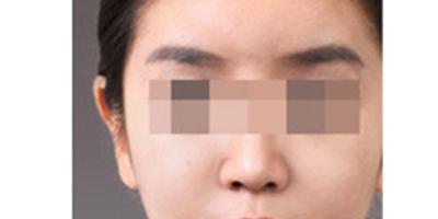 自體脂肪豐眉弓術(shù)后