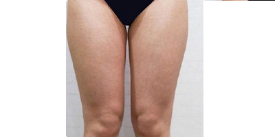 超聲溶脂瘦大腿術(shù)前