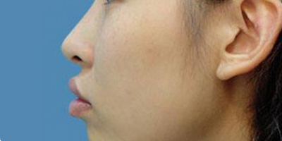 上下顎手術(shù)/突嘴矯正術(shù)前