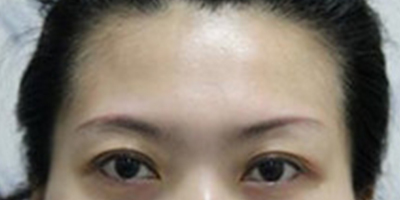 自體脂肪豐太陽穴術(shù)前