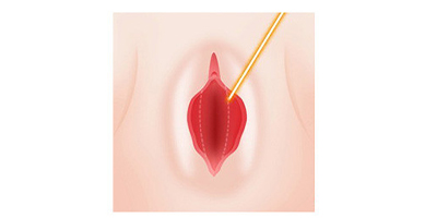 小陰唇手術術前