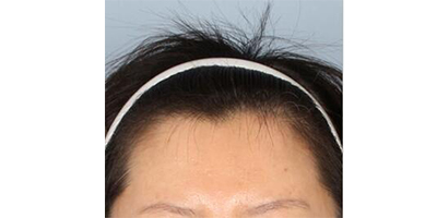 脫發(fā)際線術前