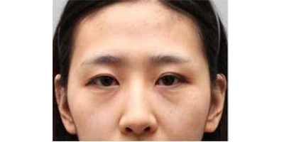 膠原蛋白填充淚溝術(shù)前