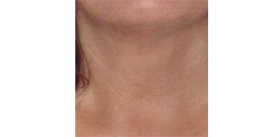 玻尿酸去頸紋術后