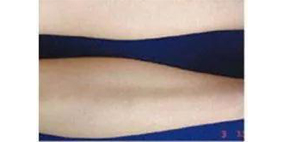 大小腿脫毛術(shù)后