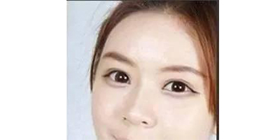 玻尿酸豐臥蠶術后