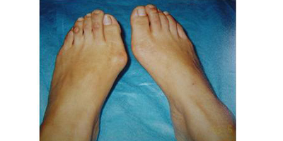 大腳骨矯正術(shù)前