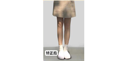 xo型腿矯正術(shù)后