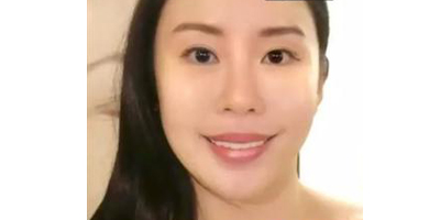 三文魚針術(shù)后