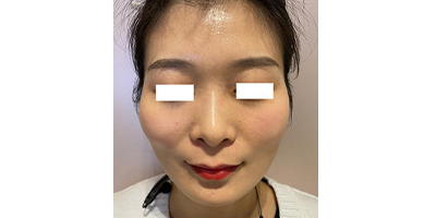 玻尿酸豐太陽穴術(shù)前