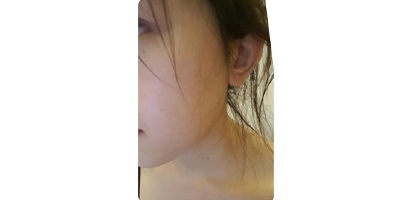 水楊酸煥膚術(shù)后