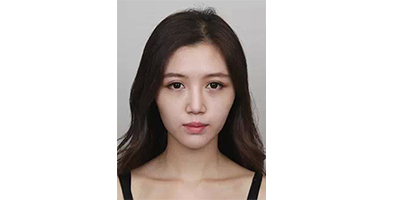 玻尿酸豐蘋果肌術前