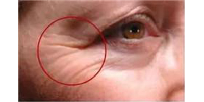 膠原蛋白注射術(shù)前