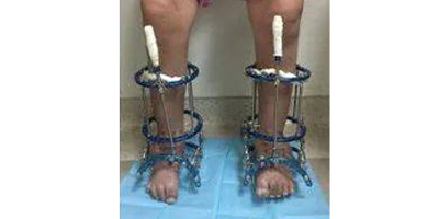 馬蹄足矯正術(shù)后