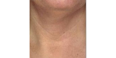 玻尿酸去頸紋術前