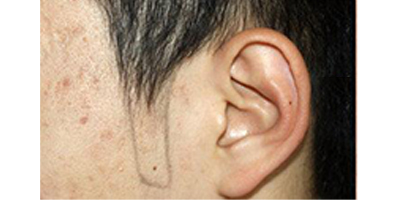 種植鬢角術(shù)前