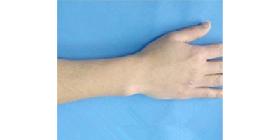 手腳脫毛術(shù)前