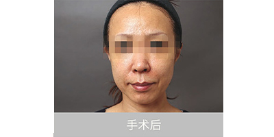 自體脂肪存儲(chǔ)術(shù)后