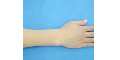 手腳脫毛術(shù)后