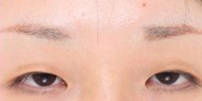 假體墊眉弓術(shù)前