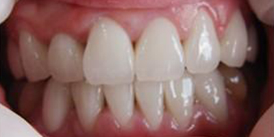 合金烤瓷牙術后