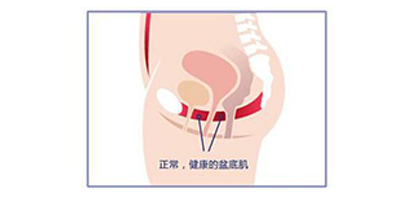 盆底肌修復術后