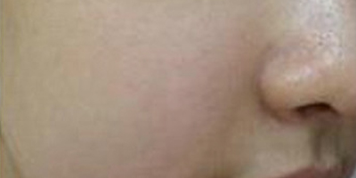 水光補水術(shù)后