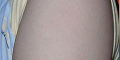 擴張器祛疤術(shù)后